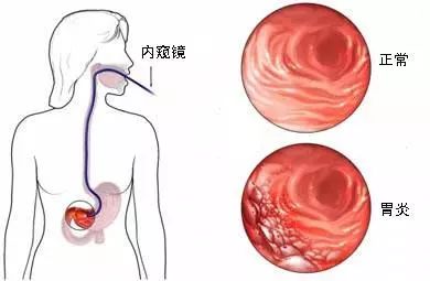 一枚小膠囊，看清你的胃！